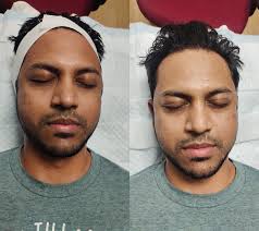 Pigmentation & Tan Treatment Rajahmundry