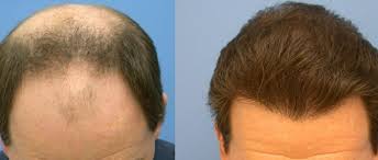 Hair Loss & PRP Treatment Rajahmundry