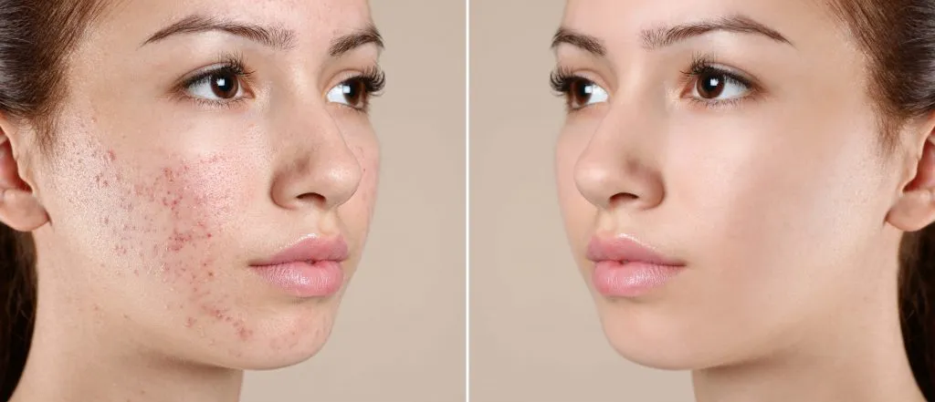 Acne & Pimple Treatment