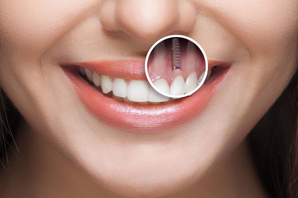 Dental Implants in Rajahmundry